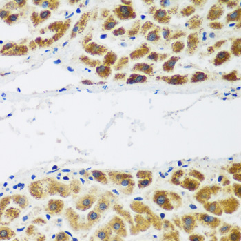 Immunohistochemistry of paraffin-embedded Human liver cancer using NAA60 Polyclonal Antibody at dilution of  1:200 (40x lens).