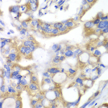 Immunohistochemistry of paraffin-embedded Human liver cancer using PNLIP Polyclonal Antibody at dilution of  1:100 (40x lens).