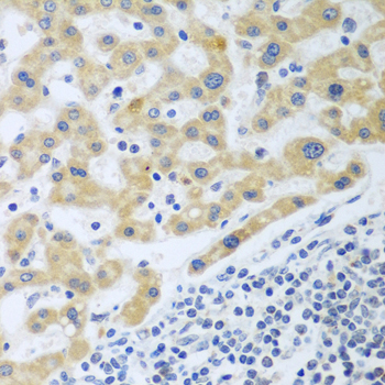 Immunohistochemistry of paraffin-embedded Human liver cancer using SHBG Polyclonal Antibody at dilution of  1:100 (40x lens).
