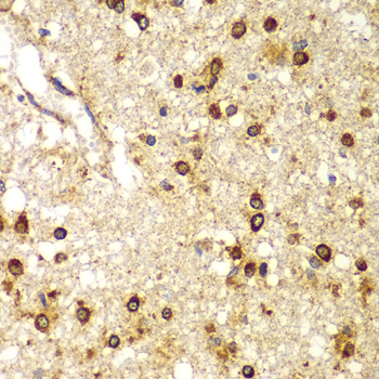 Immunohistochemistry of paraffin-embedded Human brain cancer using SMAD9 Polyclonal Antibody at dilution of  1:100 (40x lens).