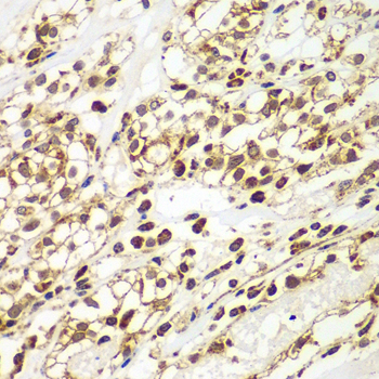 Immunohistochemistry of paraffin-embedded Human kidney cancer using SMAD9 Polyclonal Antibody at dilution of  1:100 (40x lens).