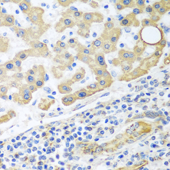 Immunohistochemistry of paraffin-embedded Human liver cancer using GLUD1 Polyclonal Antibody at dilution of  1:100 (40x lens).