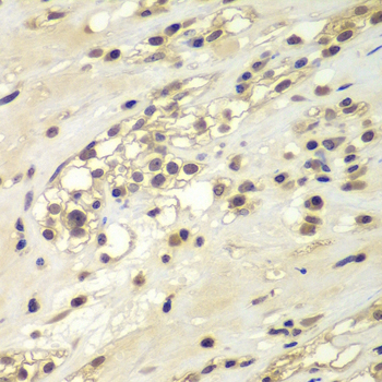 Immunohistochemistry of paraffin-embedded Human kidney cancer using CHEK1 Polyclonal Antibody at dilution of  1:100 (40x lens).