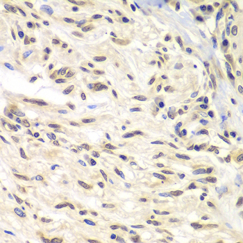 Immunohistochemistry of paraffin-embedded Human gastric cancer using CHEK1 Polyclonal Antibody at dilution of  1:100 (40x lens).