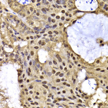 Immunohistochemistry of paraffin-embedded Human oophoroma using ARID3A Polyclonal Antibody at dilution of  1:100 (40x lens).