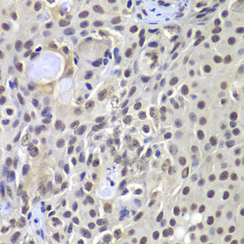 Immunohistochemistry of paraffin-embedded Human well-differentiated squamous skin carcinoma using PRKDC Polyclonal Antibody at dilution of  1:100 (40x lens).