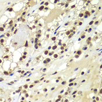 Immunohistochemistry of paraffin-embedded Human kidney cancer using PRKDC Polyclonal Antibody at dilution of  1:100 (40x lens).