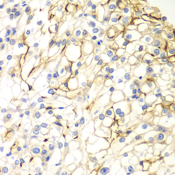 Immunohistochemistry of paraffin-embedded Human kidney cancer using VANGL2 Polyclonal Antibody at dilution of  1:100 (40x lens).