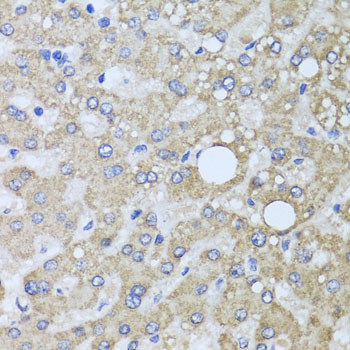 Immunohistochemistry of paraffin-embedded Human liver damage using AARS2 Polyclonal Antibody at dilution of  1:100 (40x lens).