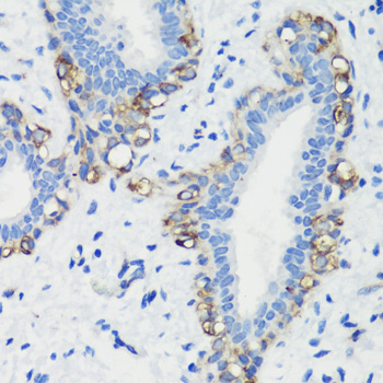 Immunohistochemistry of paraffin-embedded Human breast cancer using FLNA Polyclonal Antibody at dilution of  1:100 (40x lens).