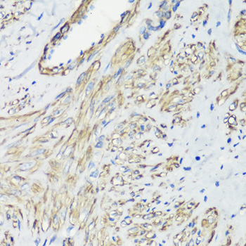 Immunohistochemistry of paraffin-embedded Human uterine cancer using FLNA Polyclonal Antibody at dilution of  1:100 (40x lens).