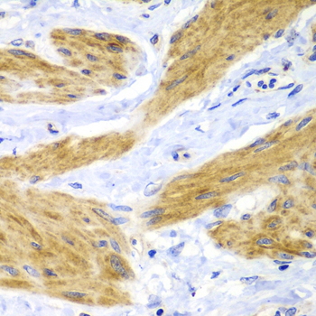 Immunohistochemistry of paraffin-embedded Human gastric cancer using HRas Polyclonal Antibody at dilution of  1:100 (40x lens).