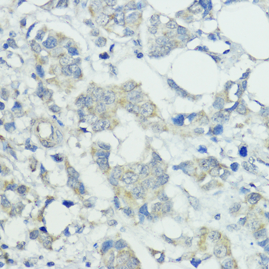 Immunohistochemistry of paraffin-embedded Human mammary cancer using SOCS5 Polyclonal Antibody at dilution of  1:100 (40x lens).