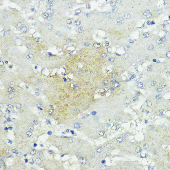 Immunohistochemistry of paraffin-embedded Human liver cancer using SOCS5 Polyclonal Antibody at dilution of  1:100 (40x lens).