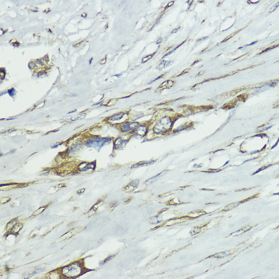 Immunohistochemistry of paraffin-embedded Human lung cancer using SOCS5 Polyclonal Antibody at dilution of  1:100 (40x lens).