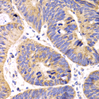 Immunohistochemistry of paraffin-embedded Human colon carcinoma using HMGCL Polyclonal Antibody at dilution of  1:100 (40x lens).