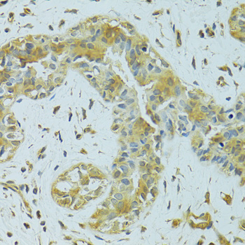 Immunohistochemistry of paraffin-embedded Human breast cancer using MTCH1 Polyclonal Antibody at dilution of  1:100 (40x lens).