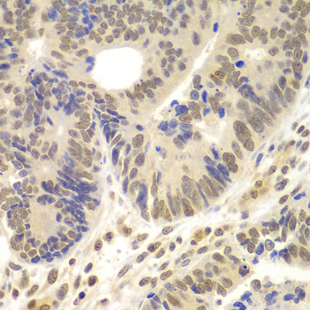Immunohistochemistry of paraffin-embedded Human colon carcinoma using LHX4 Polyclonal Antibody at dilution of  1:100 (40x lens).