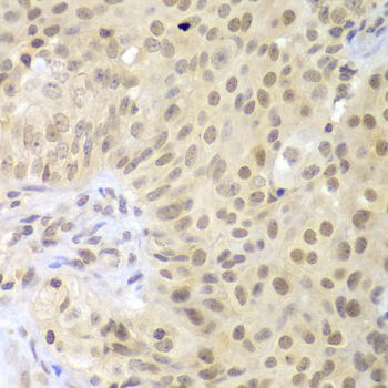 Immunohistochemistry of paraffin-embedded Human oophoroma using LHX4 Polyclonal Antibody at dilution of  1:100 (40x lens).