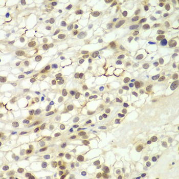 Immunohistochemistry of paraffin-embedded Human kidney cancer using LHX4 Polyclonal Antibody at dilution of  1:100 (40x lens).