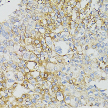 Immunohistochemistry of paraffin-embedded Human prostate cancer using MT-ND5 Polyclonal Antibody at dilution of  1:100 (40x lens).