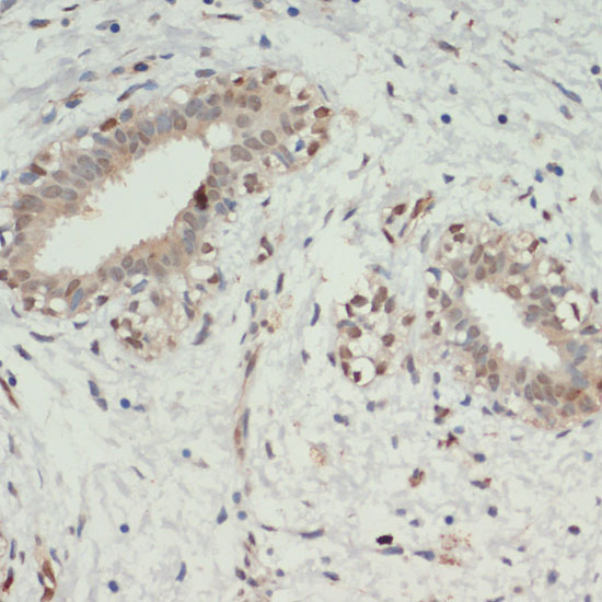 Immunohistochemistry of paraffin-embedded Human breast cancer using KDM6A Polyclonal Antibody at dilution of  1:200 (40x lens).