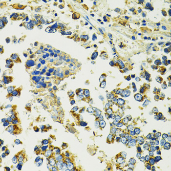 Immunohistochemistry of paraffin-embedded Human colon carcinoma using SLC25A11 Polyclonal Antibody at dilution of  1:100 (40x lens).