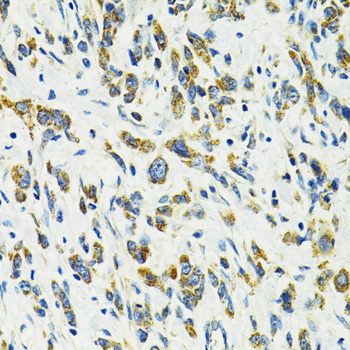 Immunohistochemistry of paraffin-embedded Human gastric cancer using SLC25A11 Polyclonal Antibody at dilution of  1:100 (40x lens).