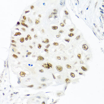 Immunohistochemistry of paraffin-embedded Human lung cancer using THOC1 Polyclonal Antibody at dilution of  1:100 (40x lens).
