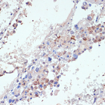 Immunohistochemistry of paraffin-embedded Human lung cancer using WNT5B Polyclonal Antibody at dilution of  1:100 (40x lens).