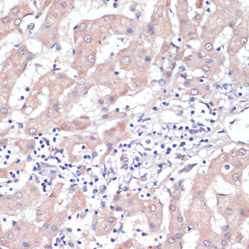 Immunohistochemistry of paraffin-embedded Human liver cancer using WNT5B Polyclonal Antibody at dilution of  1:100 (40x lens).