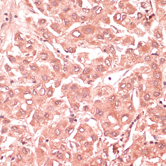 Immunohistochemistry of paraffin-embedded Human liver cancer using RNF5 Polyclonal Antibody at dilution of  1:100 (40x lens).