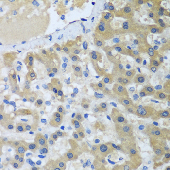 Immunohistochemistry of paraffin-embedded Human liver cancer using XPC Polyclonal Antibody at dilution of  1:100 (40x lens).