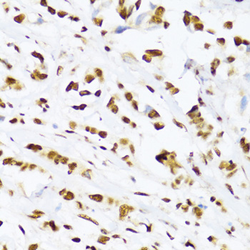 Immunohistochemistry of paraffin-embedded Human breast cancer using DDX39B Polyclonal Antibody at dilution of  1:100 (40x lens).
