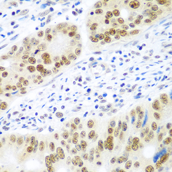 Immunohistochemistry of paraffin-embedded Human colon carcinoma using MDC1 Polyclonal Antibody at dilution of  1:100 (40x lens).