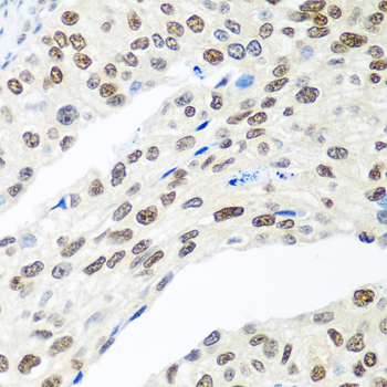 Immunohistochemistry of paraffin-embedded Human prostate cancer using MDC1 Polyclonal Antibody at dilution of  1:100 (40x lens).