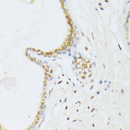 Immunohistochemistry of paraffin-embedded Human breast cancer using ANKRD52 Polyclonal Antibody at dilution of  1:100 (40x lens).