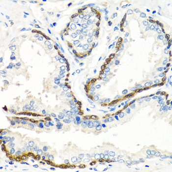 Immunohistochemistry of paraffin-embedded Human prostate using BMP5 Polyclonal Antibody at dilution of  1:100 (40x lens).