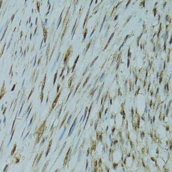 Immunohistochemistry of paraffin-embedded Human uterine cancer using GABPA Polyclonal Antibody at dilution of  1:100 (40x lens).