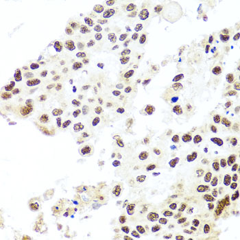 Immunohistochemistry of paraffin-embedded Human lung cancer using HIRA Polyclonal Antibody at dilution of  1:100 (40x lens).