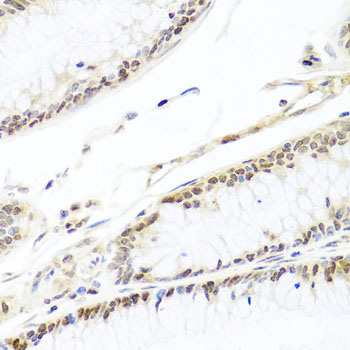 Immunohistochemistry of paraffin-embedded Human colon carcinoma using HIRA Polyclonal Antibody at dilution of  1:100 (40x lens).