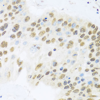 Immunohistochemistry of paraffin-embedded Human lung cancer using ZBTB17 Polyclonal Antibody at dilution of  1:100 (40x lens).