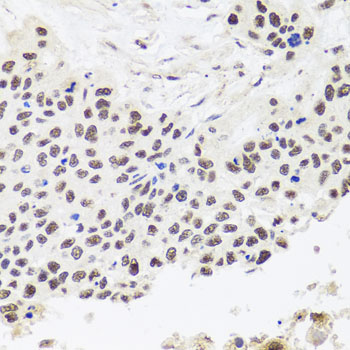 Immunohistochemistry of paraffin-embedded Human lung cancer using RPP30 Polyclonal Antibody at dilution of  1:100 (40x lens).