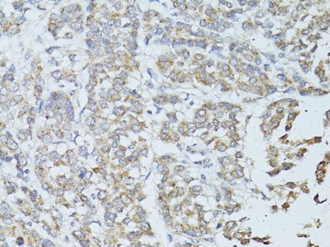 Immunohistochemistry of paraffin-embedded Human colon carcinoma using TEFM Polyclonal Antibody at dilution of  1:100 (40x lens).