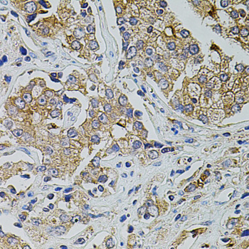 Immunohistochemistry of paraffin-embedded Human prostate cancer using TRPA1 Polyclonal Antibody at dilution of  1:100 (40x lens).