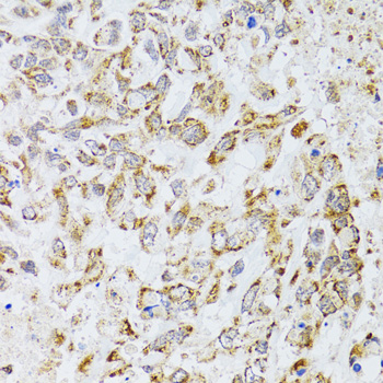 Immunohistochemistry of paraffin-embedded Human lung cancer using AIFM3 Polyclonal Antibody at dilution of  1:100 (40x lens).