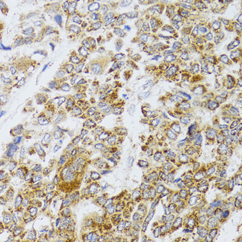 Immunohistochemistry of paraffin-embedded Human liver cancer using AIFM3 Polyclonal Antibody at dilution of  1:100 (40x lens).