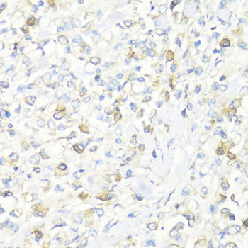 Immunohistochemistry of paraffin-embedded Human gastric cancer using EIF3J Polyclonal Antibody at dilution of  1:100 (40x lens).