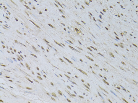 Immunohistochemistry of paraffin-embedded Human uterine cancer using HDGFRP3 Polyclonal Antibody at dilution of  1:100 (40x lens).