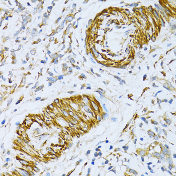 Immunohistochemistry of paraffin-embedded Human gastric cancer using VAMP1 Polyclonal Antibody at dilution of  1:100 (40x lens).